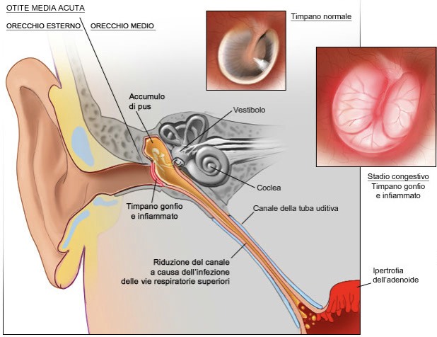 MD_otite_media_osteopata